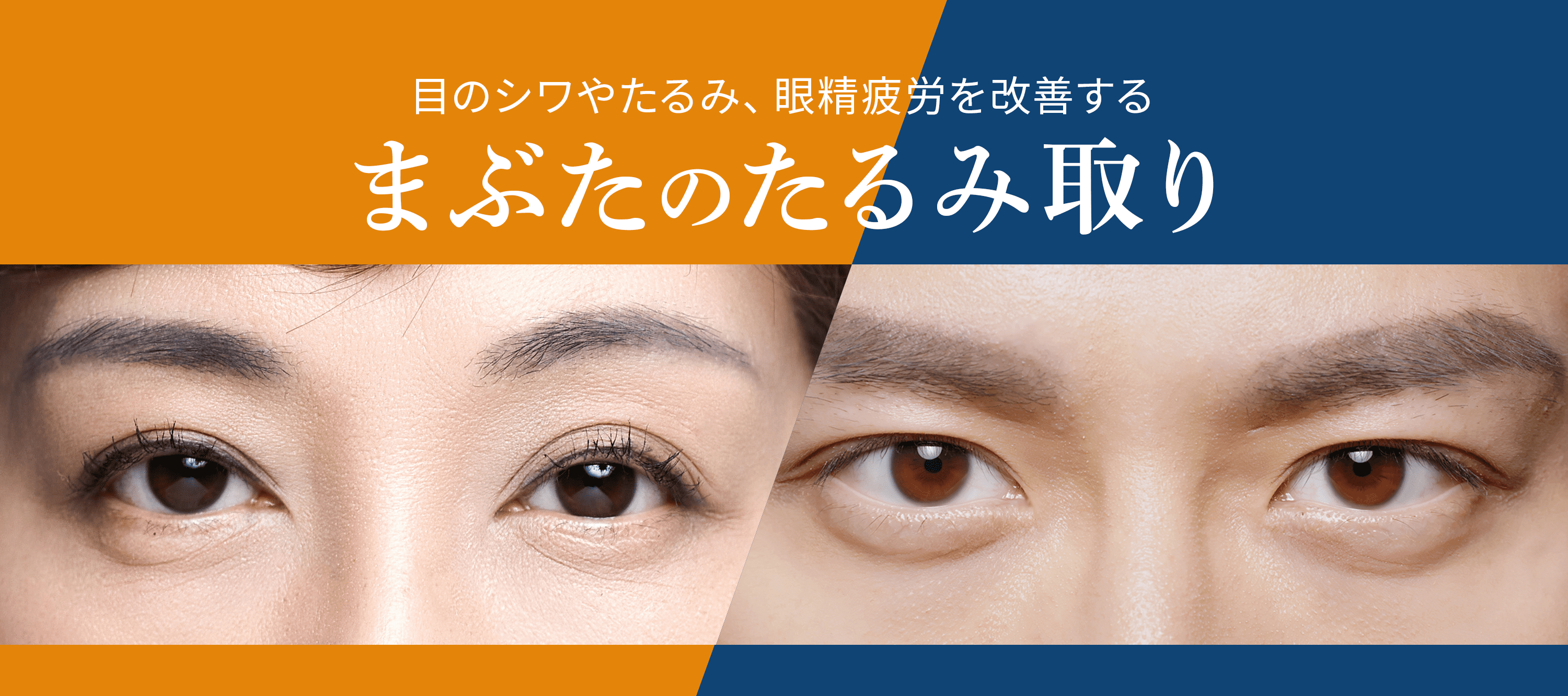 目のシワやたるみ、眼精疲労を改善するまぶたのたるみ取り